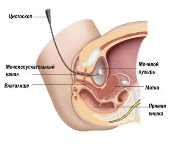 Цистоскопия у женщин