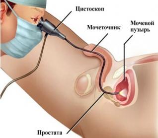 Цистоскопия у мужчин