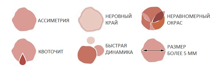 Изменения родинок