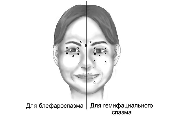 Блефароспазм: причины, симптомы, диагностика и лечение