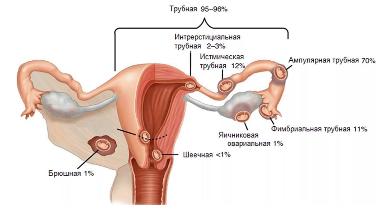 Воспаление яичников и придаток: симптомы и методы лечения